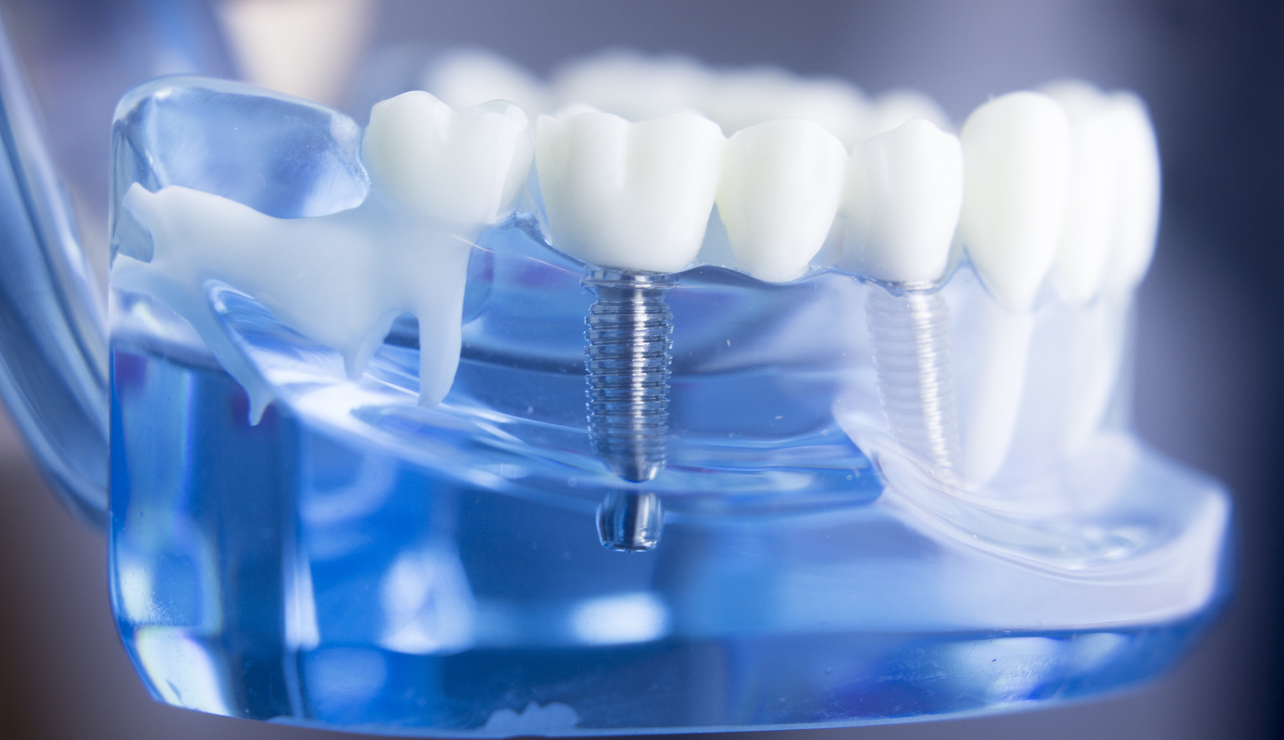 North Texas Dental Implants Colleyville, TX Dental Specialists Center